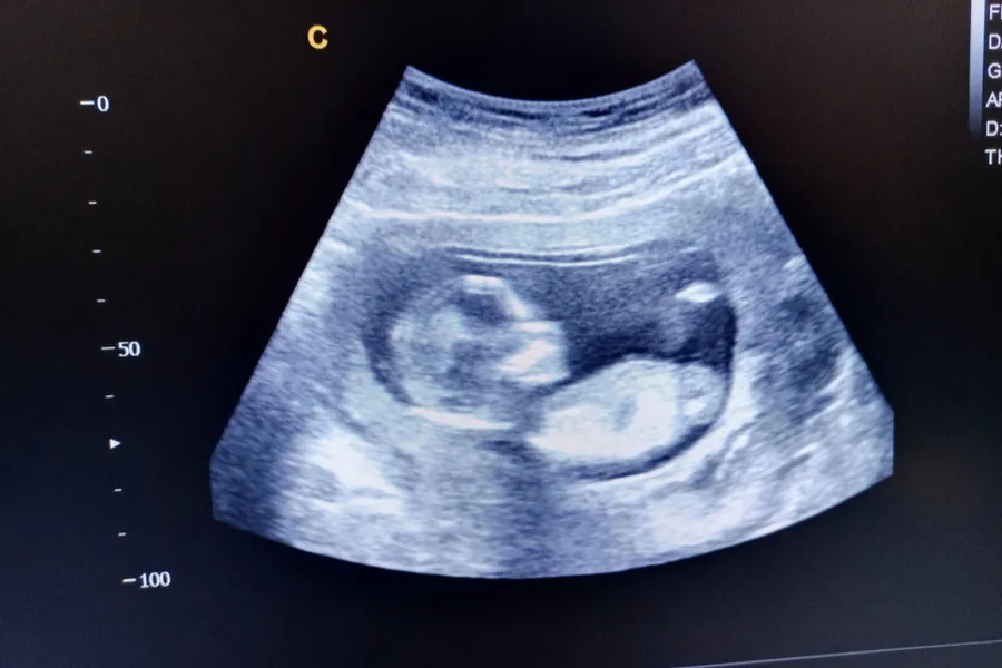 Ultrasound scan of 15-week-old baby?w=200&h=150